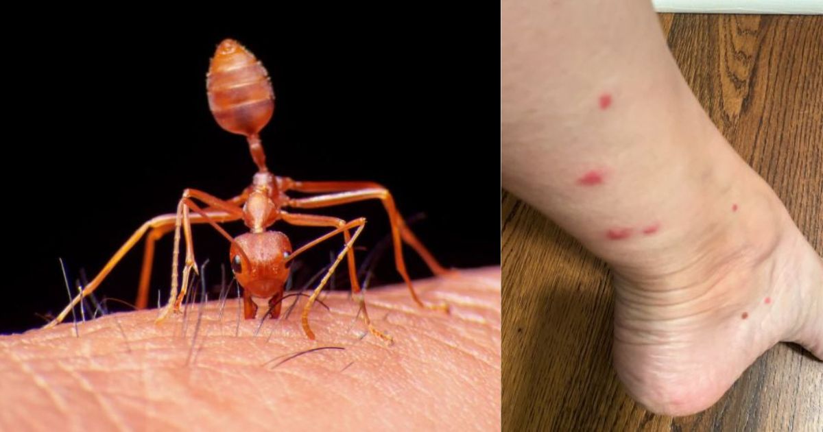 Ant Bite Home Remedies