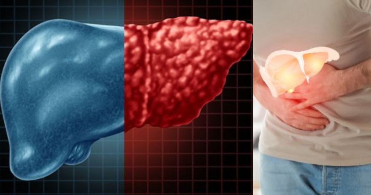 Fatty Liver Symptoms