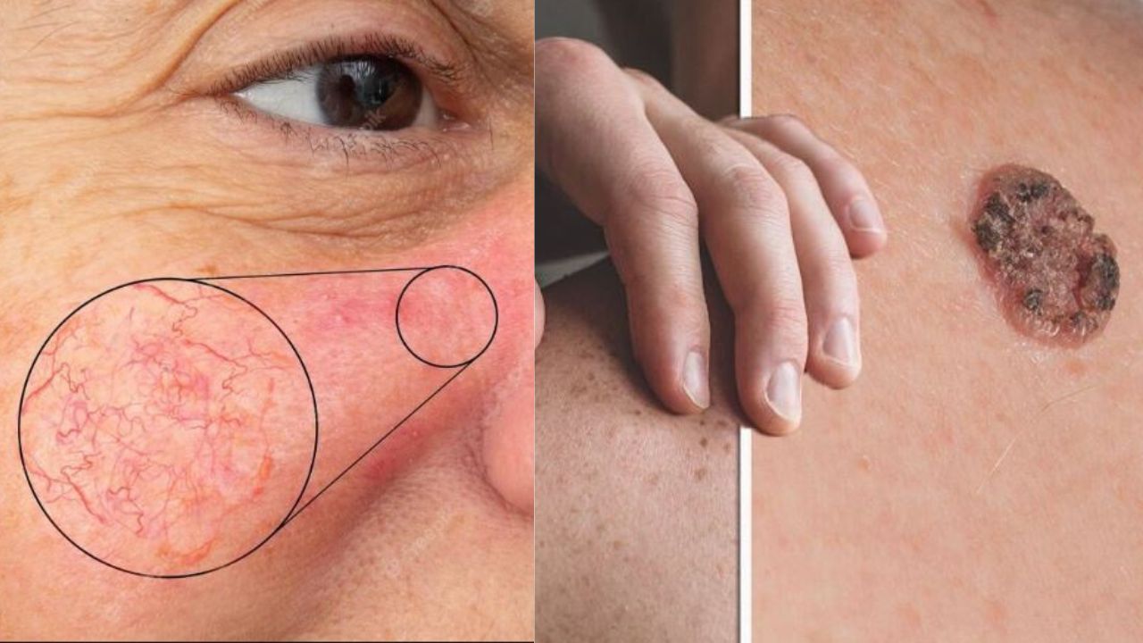 Skin Cancer Symptoms