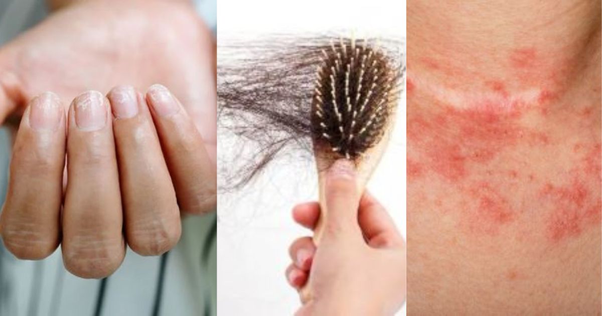 Vitamin-D Deficiency Symptoms