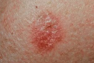 Skin Cancer Symptoms