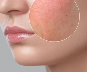 Vitamin-D Deficiency Symptoms