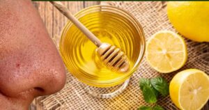 ब्लैकहेड्स से पाएं छुटकारा 