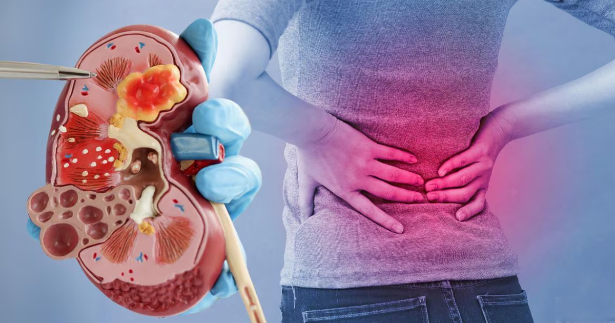 Kidney Cancer Symptoms 