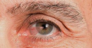Pterygium eye disease can affect vision.